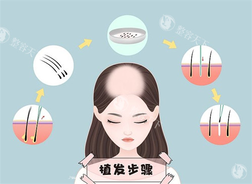 重庆华肤皮肤病医院毛发科价格表：FUE四代12元/AHT16元，查看2025植发单价明细不踩坑