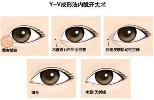 哈尔滨整形医院价格表2025年新版：开眼角6000元起/蒜头鼻整形8000元起/胸部假体取出35000元起