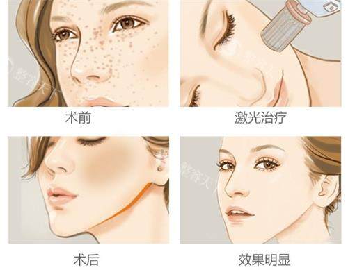 美国赛诺秀C6祛斑怎么样？解析技术原理、结果、适用人群等