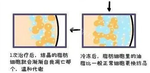 重庆酷塑冷冻减脂哪里有？铜雀台整形医院可靠推荐，没有创口甩掉顽固脂肪不留痕