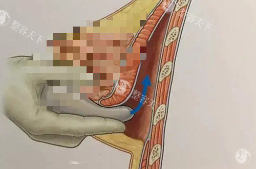 深圳美莱隆胸哪个医生好？徐占锋|郭杰|黎冻三位是隆胸建议面诊的医生~