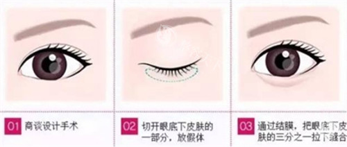 哈尔滨名大医疗美容所院长做卧蚕再造怎么样?技术造诣深|审美非常好|临床病例很受好评