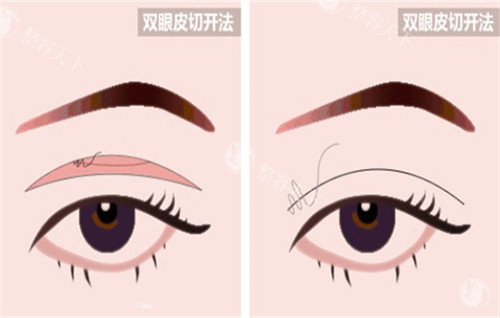 汕头双眼皮哪家医院做的好？这四家医美机构是本地割双眼皮靠谱医院