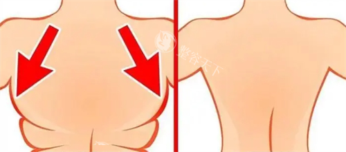 王阳医生抽脂多少钱一次?腰腹/大腿/手臂等热门部位收费分享:大腿6w+小腿3w+