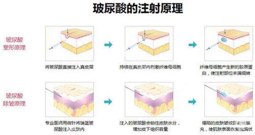 润致玻尿酸单相、1号、2号、3号和5号区别：从分子大小、适用部位、维持时间等对比