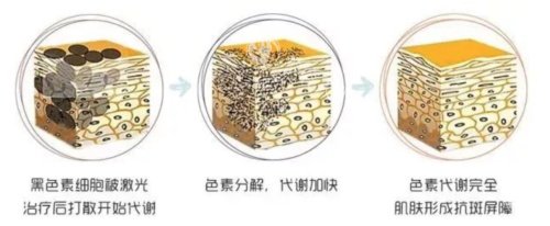 美国赛诺秀C6祛斑怎么样？解析技术原理、结果、适用人群等