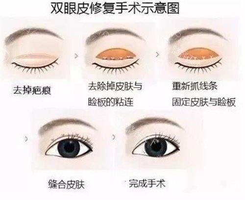 广州华美林晓燕擅长什么项目?做眼整形/眼部修复很不错,高难度眼修复口碑好