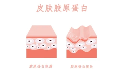 脸上注射胶原蛋白用什么牌子好？双美、薇旖美、弗缦和爱贝芙等可以放心选