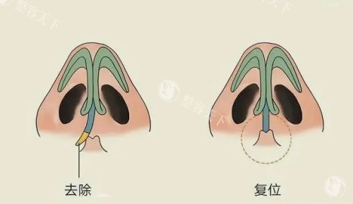李信锋鼻整形贵吗？深度解析价格与价值！