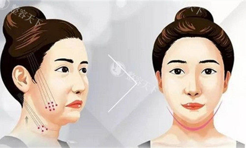 双面网兜提升是埋线提升吗？二者在手术原理、结果、适用人群、维持时间等存在差异