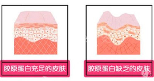 脸上注射胶原蛋白用什么牌子好？双美、薇旖美、弗缦和爱贝芙等可以放心选