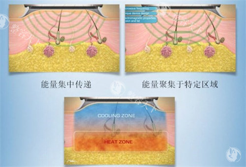 衡水清新微波治狐臭多少钱？一篇看懂衡水清新微波治狐臭费用与结果！