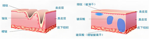 乔雅登哪个系列适合打鼻子？极致系列、丰颜系列和朔颜 XC 系列都可以