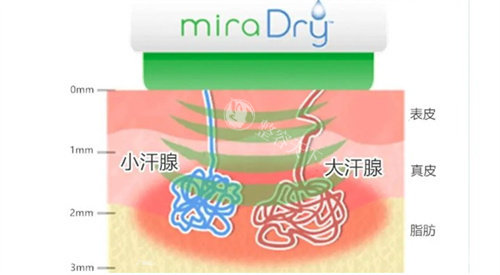衡水清新微波治狐臭多少钱？一篇看懂衡水清新微波治狐臭费用与结果！