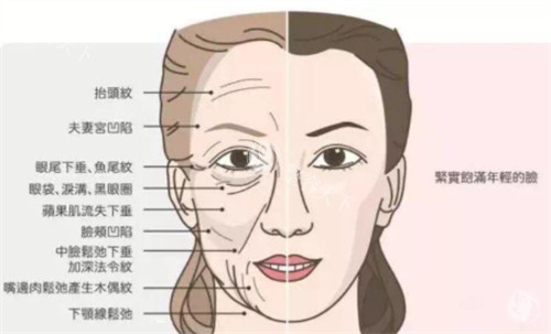濡白天使针和少女针填充哪个好？从二者成分/适应症/作用功效/维持时间方面来看都不错