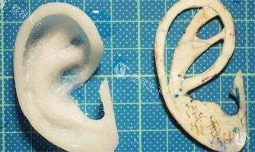 耳再造是自体软骨好还是生物材料好？两种主流方案各有特色没有谁更好，关键在于匹配个体需求！