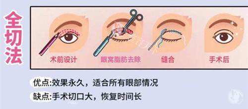 北京李燕医生双眼皮怎么样啊？技术优势与真实口碑深度解析！