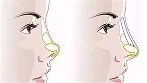 介绍上海做鼻子比较出名的医生：顾斌|冯少清|李健|范荣杰|戴传昌鼻整形技术非常好