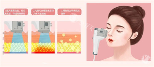 50岁做超声炮有效吗？真人对比图+抗衰性价比分析！