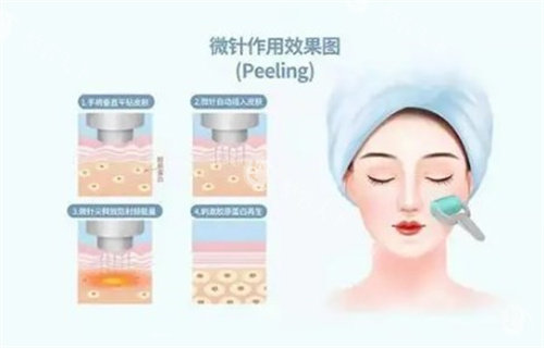 伊诺锶黄金微针怎么样？是哪国的？多少钱一次？