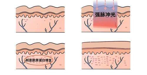 嘉兴艺星光子嫩肤怎么样？​不仅设备齐全且做完后的成效比较受欢迎！