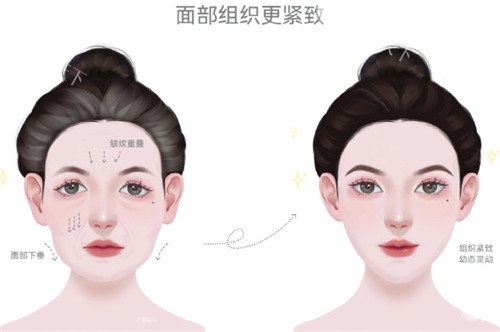 做幼态脸大概多少钱？注射/手术不同方案费用详解！