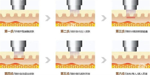 帝医思黄金微针怎么样？帝医思黄金微针是进口中高端正规品牌，淡纹紧致成效好