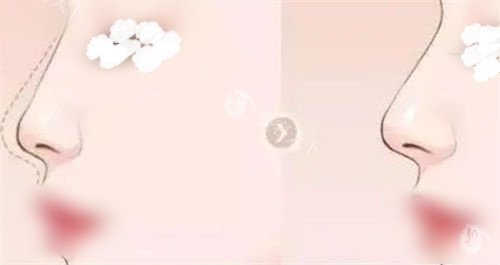 温州艺星整形医院黄泽春医生鼻整形很有名，大量的成功病例+操作技术娴熟做鼻子很推荐