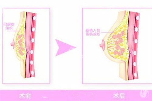北京禾美嘉脂肪隆胸日记：全麻过程无记忆，术后直接增大 1.5 杯，存活率高无硬块，动态结果超自然​