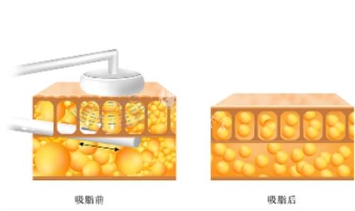 张丁山医生吸脂怎么样？腰腹环吸术后凹凸不平预防！