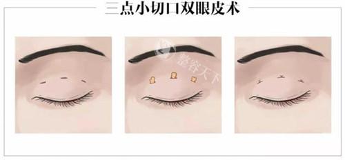 任天平修复双眼皮好吗？疤痕粘连修复技术解读！