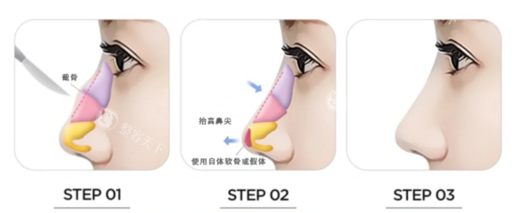 吴玉家做鼻子靠谱吗？​不仅技术娴熟且术后的口碑比较好！