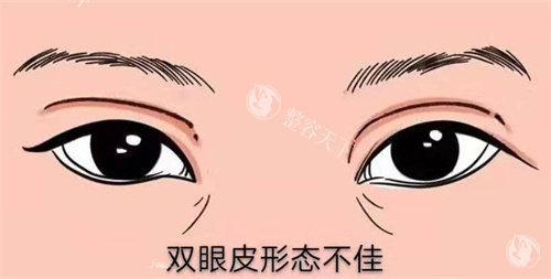 成都双眼皮修复找江涛医生靠谱吗？我的真实修复经历给你答案​