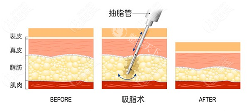 武汉吸脂手术费用多少钱？2025价格表！单部位吸脂980元起/面部15000元起/大腿6800元起！