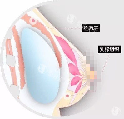 西安丰胸手术多少钱？曼托假体13800元起/傲诺拉45000元起/脂肪隆胸16800元起/复合隆胸3万元起！