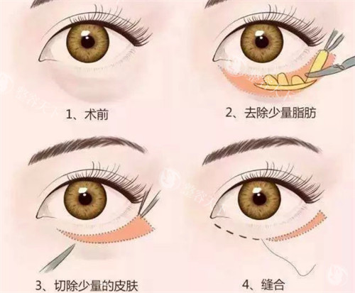 西安孙峰眼袋失败修复到底要花多少钱？不同情况16800元至39800元不等，这份价目攻略请收好！
