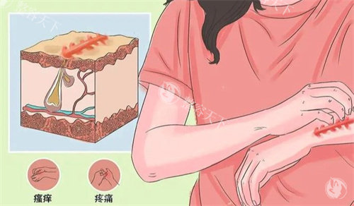 十厘米疤痕修复后如何护理？综合医院术后护理费用！