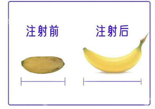 分享5年全去韩国阴茎增大手术亲历:增长增粗我都要!尺寸大了一倍
