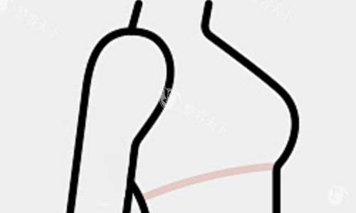 曼托假体可以一辈子不取吗？曼托假体的使用期限一般在8至10年左右