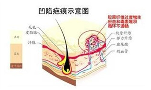 武晓莉做疤痕好还是刘伟好？武晓莉擅综合治疗，刘伟创特色疗法，各有优势！
