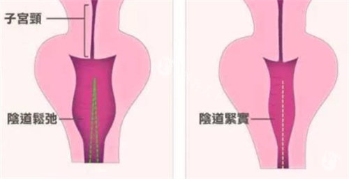八爪鱼紧缩术价格多少钱?价格2万-9万元起!成效/维持年限揭晓