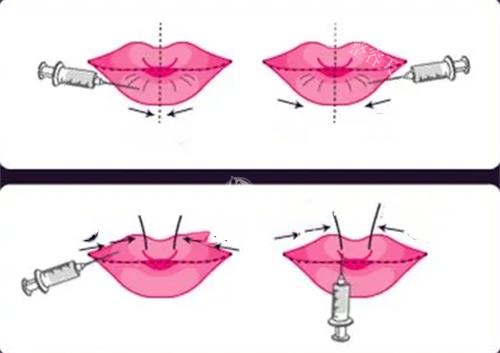 海魅玻尿酸多少钱一支？基础系列6000元起、月白系列4800元起