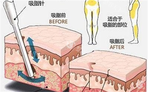 临沂整形医院价格表2025年全新：上睑下垂矫正8000元起/吸脂手术2000元起/自体脂肪填充太阳穴8000元起