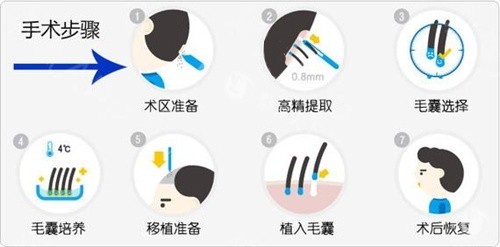 长沙大麦微针植发口碑非常好!植发技术专科+术后成活率高+服务贴心周到|患者评价都说自然
