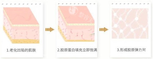 胶原蛋白注射填充泪沟多少钱一针？价格一般从2000元起