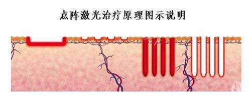 点阵激光治疗疤痕成效好吗？真实术例对比+术后护理指南，凹凸疤/痘坑能否平滑如新一次说清！