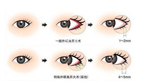 新乡整形医院价格表2025年更新：开眼角6000元起/小拉皮手术3W元起/自体脂肪填充鼻唇沟8000元起