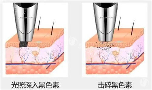 深度解析:手术切除纹身费用一般是多少?手术切除纹身还会留疤吗?
