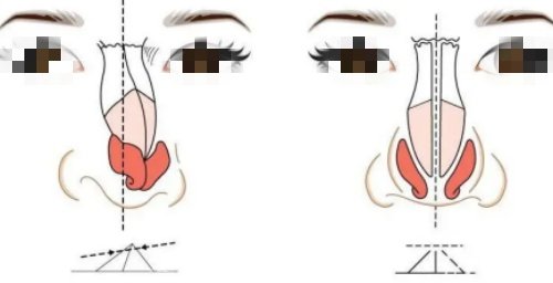 成都肖凌鼻修复技术究竟如何？真实实例与口碑揭秘！