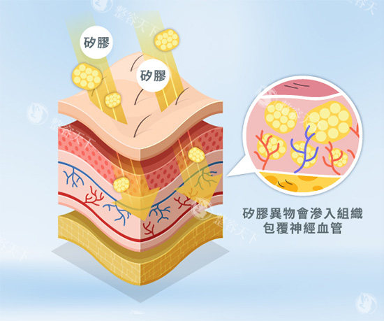 稀洛因馒化紧致针怎么打不翻车?稀洛因馒化紧致针浅打还是深打?手把手教你避开馒化脸雷区